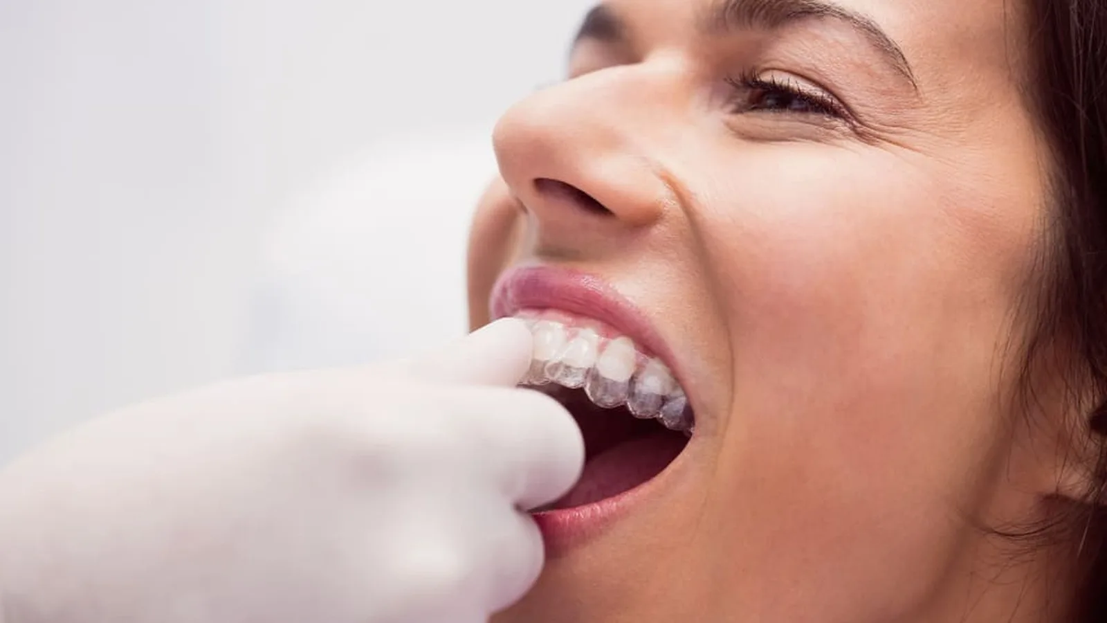Dientes chuecos o desalineados en Monterrey: síntomas y evaluación clínica