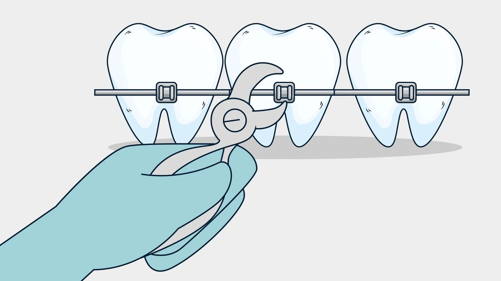 Precio de colocación de brackets metálicos en Monterrey, Nuevo León